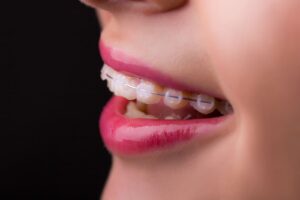 Ceramic braces treatment in Pikesville