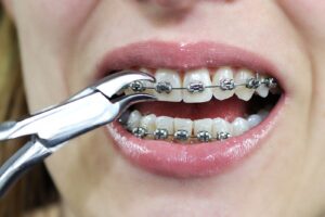 braces-pain-relief-after-adjustment