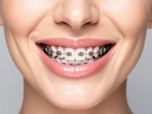 different-types-of-braces