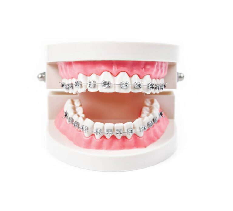 How Much Are Braces for Adults in 2026? Full Pricing Guide