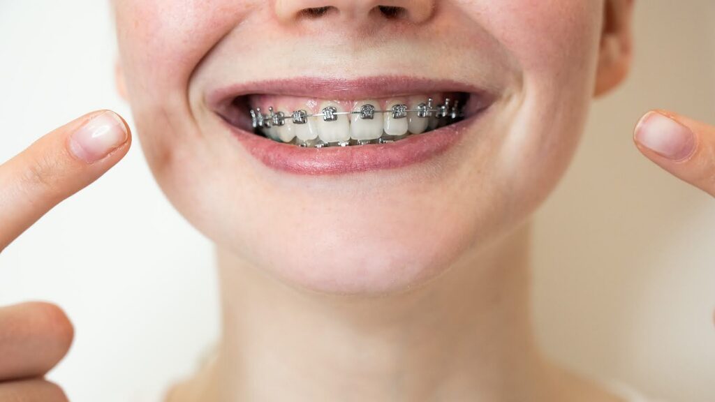 Types of braces: traditional metal braces