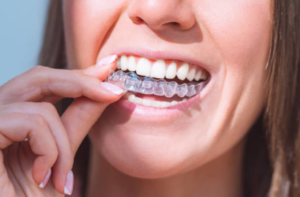 Invisalign