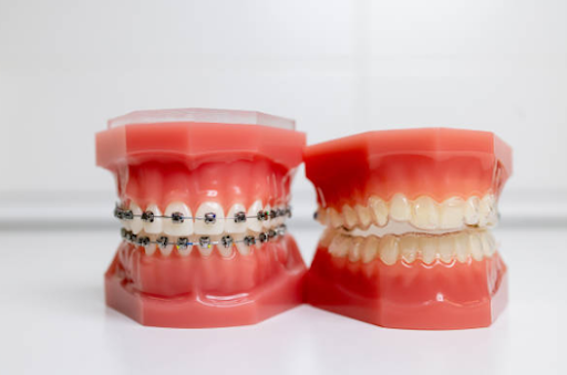 Invisalign or braces